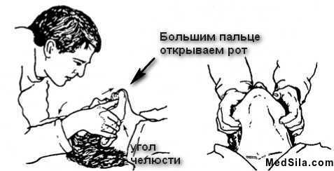 Выдвижение нижней челюсти вперед